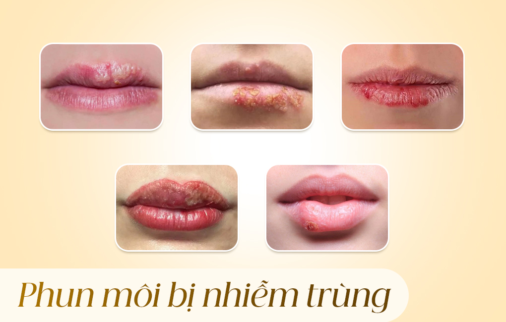 Phun môi bị nhiễm trùng: Dấu hiệu, nguyên nhân và cách xử lý