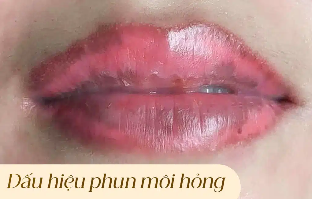 Dấu hiệu phun môi hỏng, nguyên nhân và cách khắc phục chuẩn y khoa